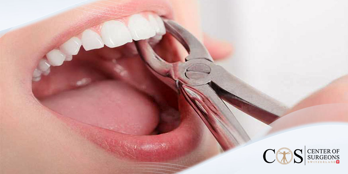 Tooth Extraction » Center of Surgeons